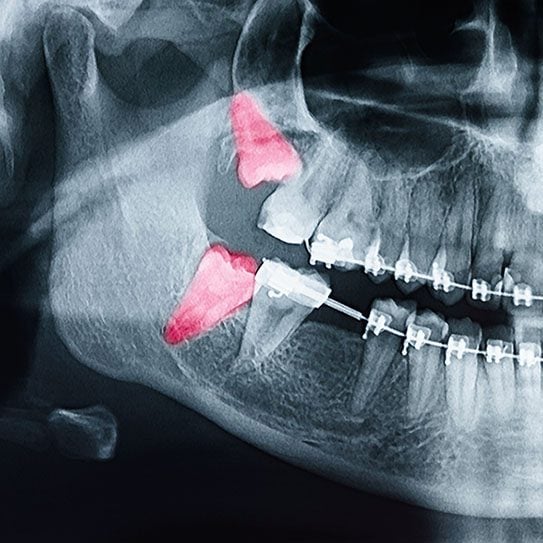 Orthodontic Treatment and Wisdom Teeth