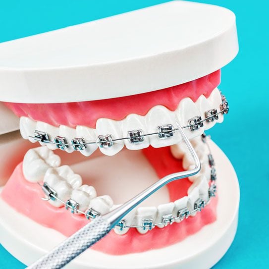 are braces expensive cost of braces NYC