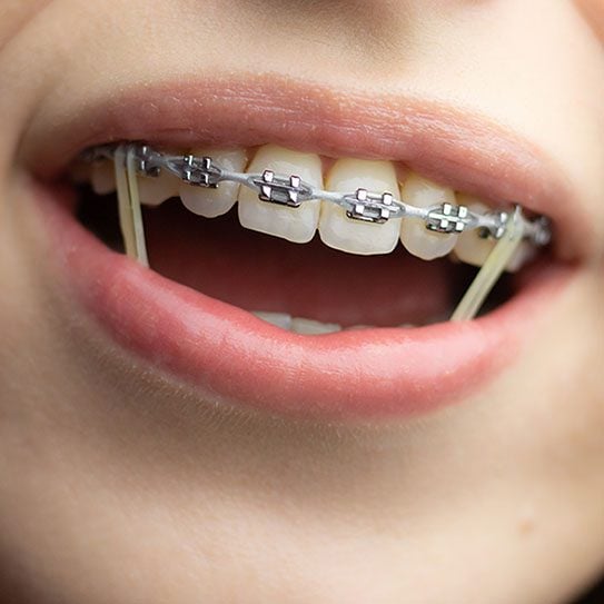 A Closer Look at Your Orthodontic Hardware