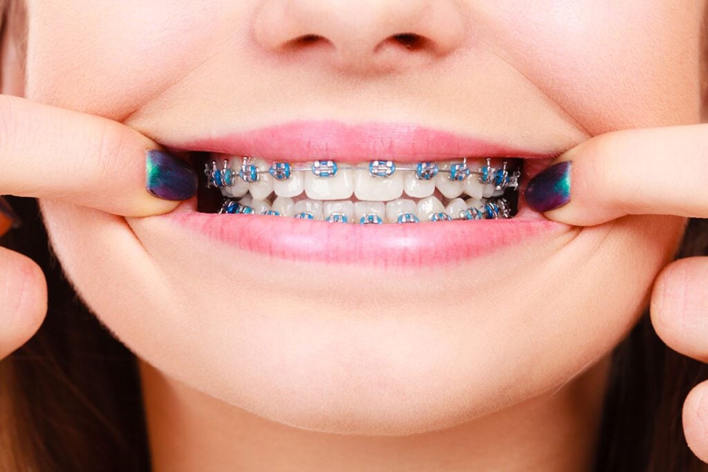 Common Treatments braces NYC